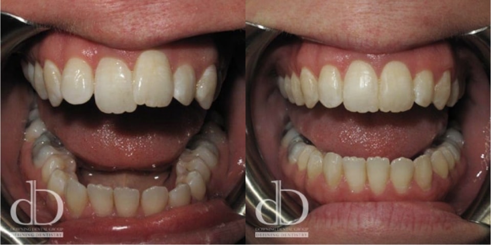 Invisible braces Solihull result