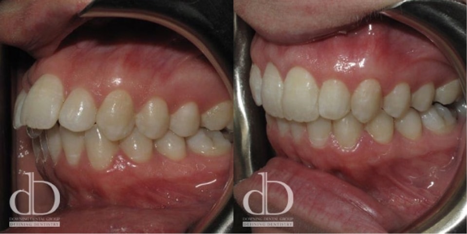Invisible braces result