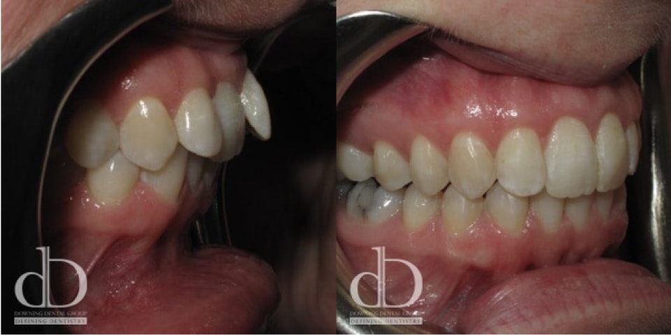 Invisible Braces Solihull