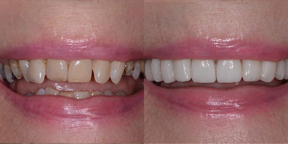 Veneers Results