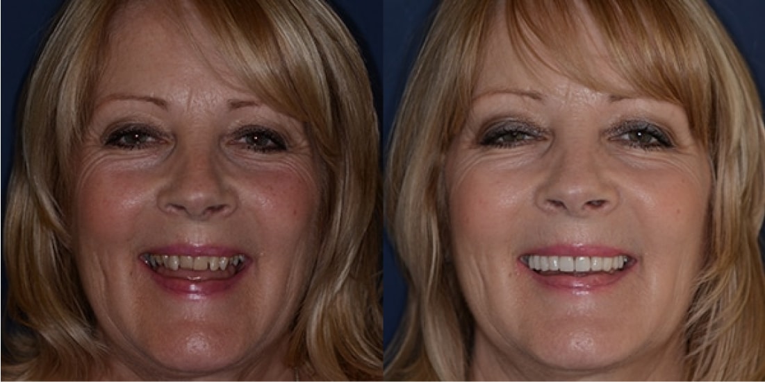 Veneers Results Solihull