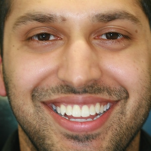 Smile Makeover After