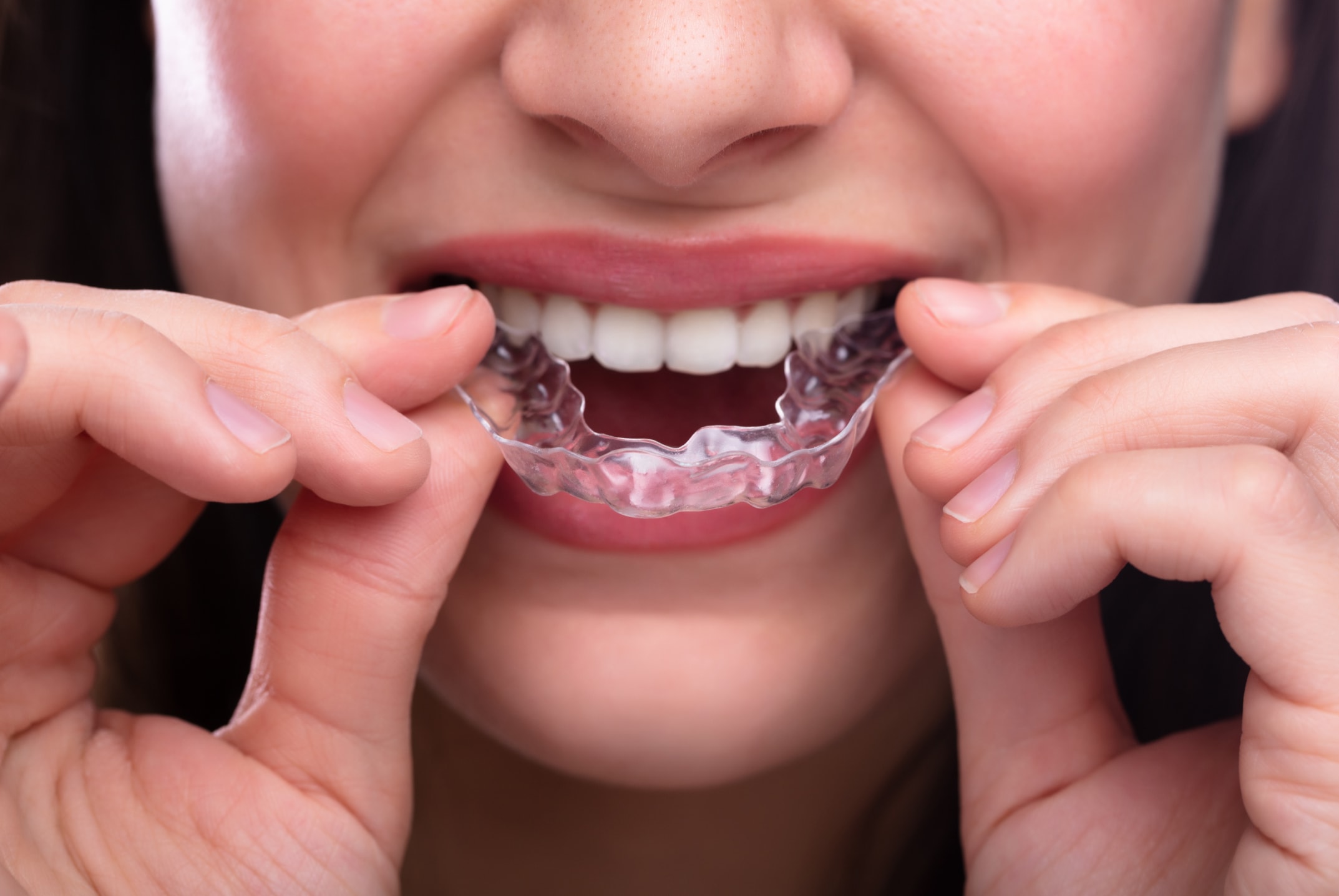 Clear Braces Solihull