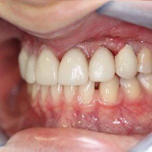 Dental Implants After Treatment