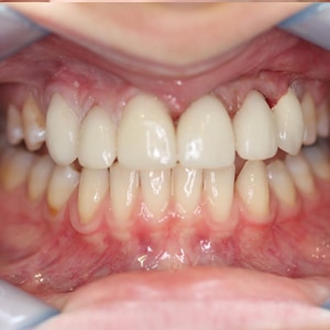 Dental Implants Result