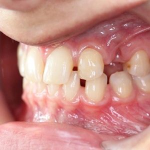 Dental Implants Before Treatment