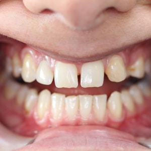 Dental Implants Before