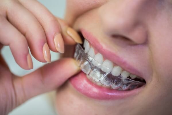 Clear braces