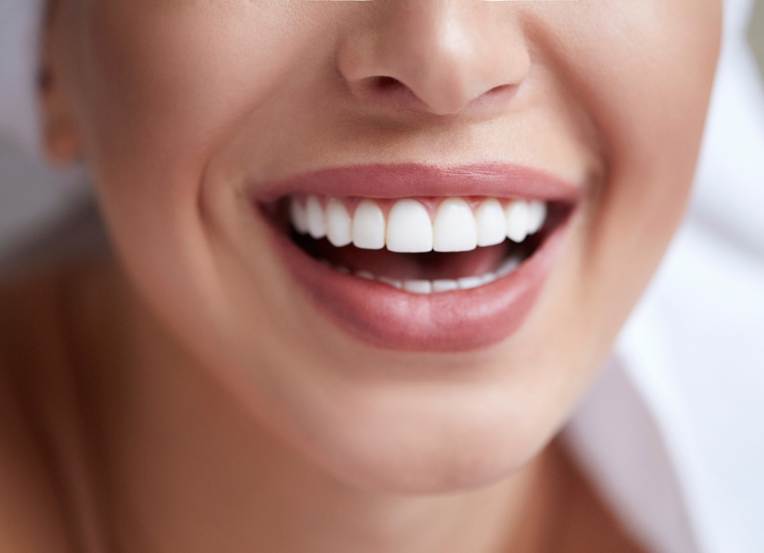 Dental Veneers Solihull